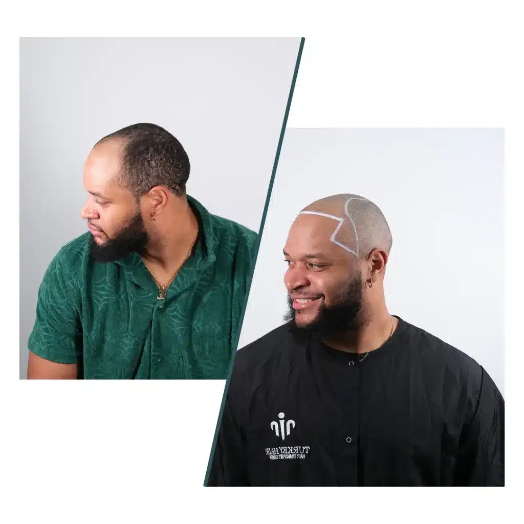 Technology founders, film stars and wrestlers live very different lives, but they share one thing: [their appearance is studied by millions](https://osdire.com/categories/photography/people-lifestyle). Hair is a big part of that. Some public figures discuss hair restoration openly, some stay silent and some have looks that have nothing to do with surgery. Three well-known names show these different paths clearly.

Why Hair Gets So Much Attention

A hairline frames the face, and small changes alter how someone looks on camera. Because public figures are photographed constantly, fans can compare images across decades. This makes hair restoration one of the most discussed topics in celebrity culture, and also one of the most misunderstood.

Elon Musk: The Most Debated Transformation

Photos from the 1990s show clear thinning at the front of his hair. Today he appears with full, dense hair. The case of [Elon Musk](https://turkeyhaircenter.com/elon-musk-hair-transplant/) is widely discussed among restoration specialists, who speculate that the change may involve more than one procedure. He has never publicly confirmed a hair transplant, so the details remain unknown.

Why this case fascinates people

1. the difference between early and recent photos is unusually large
2. the result looks natural from most angles
3. it suggests long-term planning rather than a single quick fix

[image](https://icopify.co/storage/post/images/oVGWlkokOgASHh0zBux2jKYjfnvTt5HciDBwEuW9.jpg)

John Travolta: Not a Transplant

Searches for a [Travolta hair transplant](https://turkeyhaircenter.com/john-travolta-hair-transplant/) are common, but the evidence points the other way. His density changed too quickly between appearances, while transplanted hair takes twelve to eighteen months to grow. When he shaved his head in 2019, there were no visible signs of FUT or FUE scarring. His look over the years is consistent with high-quality hair systems and professional styling.

John Cena: Openly Confirmed

The wrestler and actor took a different approach. The [John Cena hair transplant](https://turkeyhaircenter.com/john-cena-hair-transplant/) story is unusual because he confirmed it himself. After years of visible thinning at the crown, he had a first procedure in November 2024 at a clinic in Atlanta and later returned for a second session to build more density.

Why the crown is often treated in stages

The crown has a large surface and a natural swirl pattern, so it needs many grafts. Staging the work allows the team to see how the first grafts grow and protects the donor area for future needs.

[image](https://icopify.co/storage/post/images/jIaQ1oASX8MNtPq37z0E36GF7JV23rb2ZSJdDbVZ.jpg)

]

How Specialists Separate Rumour From Evidence

When restoration specialists look at a famous hairline, they do not rely on a single photo. They compare images over many years and look for patterns that are hard to fake. A hairline that improves gradually over about a year fits the way transplanted hair grows. A hairline that changes from one event to the next does not. They also check for donor scarring when the hair is cut short and consider whether the density matches the person's age and hair type.

1. a public statement is the only real confirmation
2. gradual change fits surgery; sudden change fits styling or hair systems
3. short haircuts can reveal or rule out donor scars

Three Paths, One Lesson

These cases show three different realities: an unconfirmed transformation, a famous look achieved without surgery and an openly confirmed procedure. For anyone considering treatment, the shared lessons are clear:

1. Do not assume a celebrity look came from a single operation.
2. Natural results develop slowly over about a year.
3. Large areas such as the crown may need more than one session.
4. A thorough consultation is more useful than any celebrity photo.

Conclusion

Elon Musk has never confirmed a hair transplant, John Travolta's famous hair was not one, and John Cena spoke openly about his. Understanding the difference between rumour and evidence helps patients set realistic goals and choose a plan built around their own hair, not someone else's headline.
